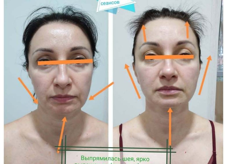 Миофасциальный массаж лица