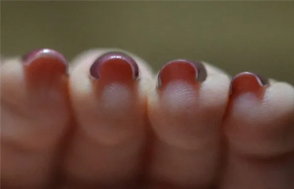 Пример закрученных ногтей