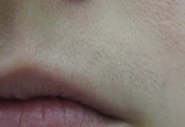 Волосы на верхней губе
